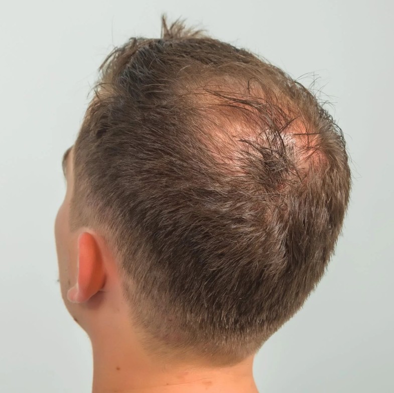 thinning hair thinning hair